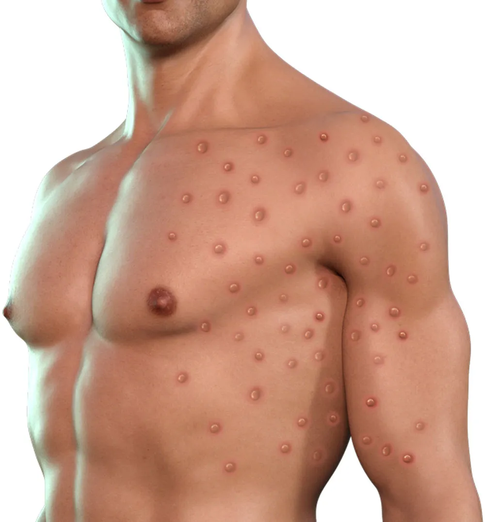 Monkeypox virus could become entrenched as new STD in the US